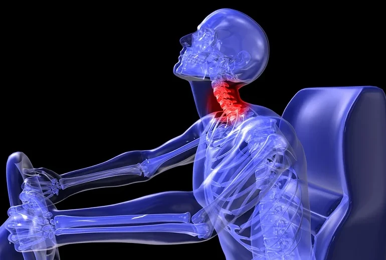X-ray illustration of a driver with a whiplash neck injury after a car accident