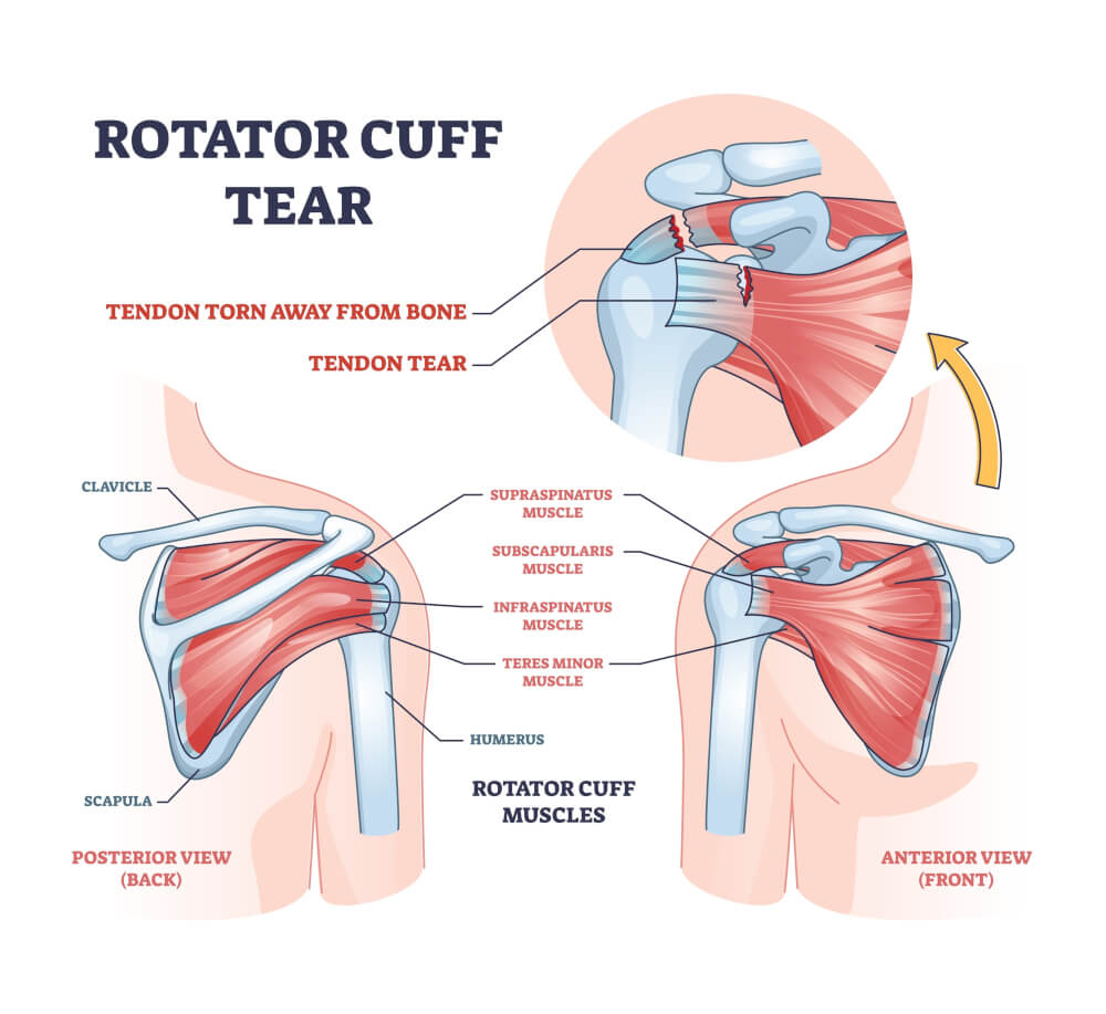 Rotator cuff tear diagram &mdash; a tendon torn away from the humerus, with the four rotator cuff muscles labeled in anterior and posterior views